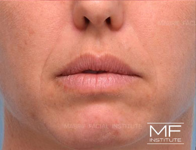 Closeup of a woman's lips before Subtle Lip Filler treatment.
