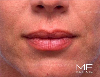Closeup of a woman's lips before Subtle Lip Filler treatment.