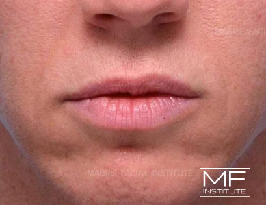 Closeup of a woman's lips before Subtle Lip Filler treatment.