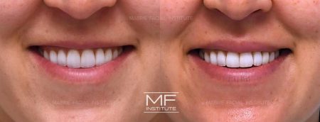 Dysport, Daxxify & XEOMIN vs. BOTOX | Mabrie Facial Institute