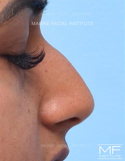woman before nonsurgical rhinoplasty