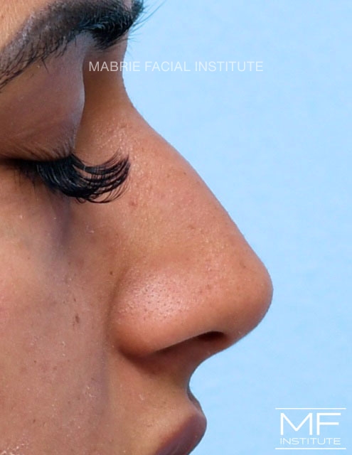 woman after one treatment of nonsurgical rhinoplasty