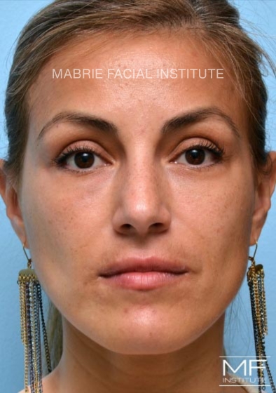 Woman after two of two nasolabial treatments