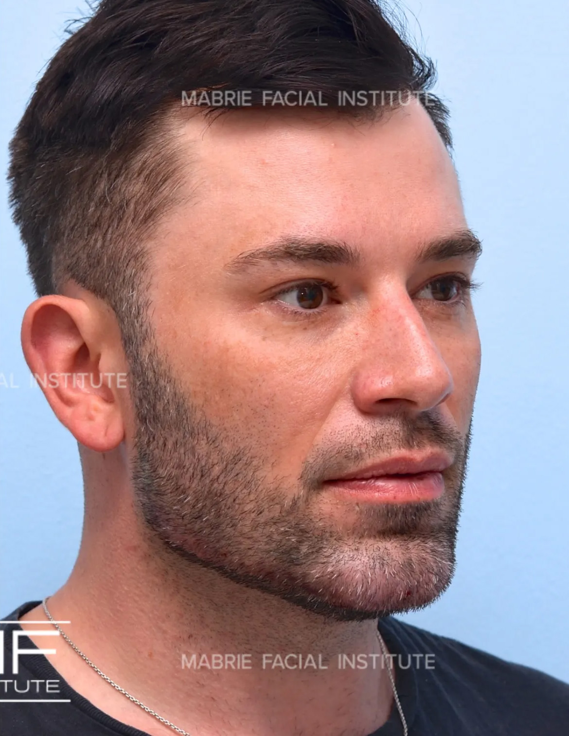 Man after the Complete Chin and Jawline Filler Package.
