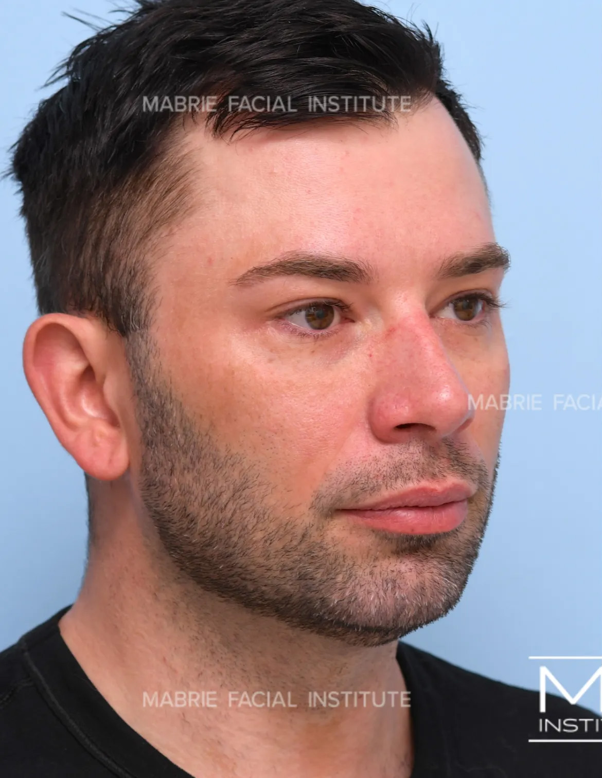 Man before the Complete Chin and Jawline Filler Package.
