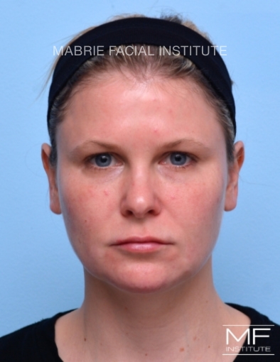 woman after facial slimming treatment