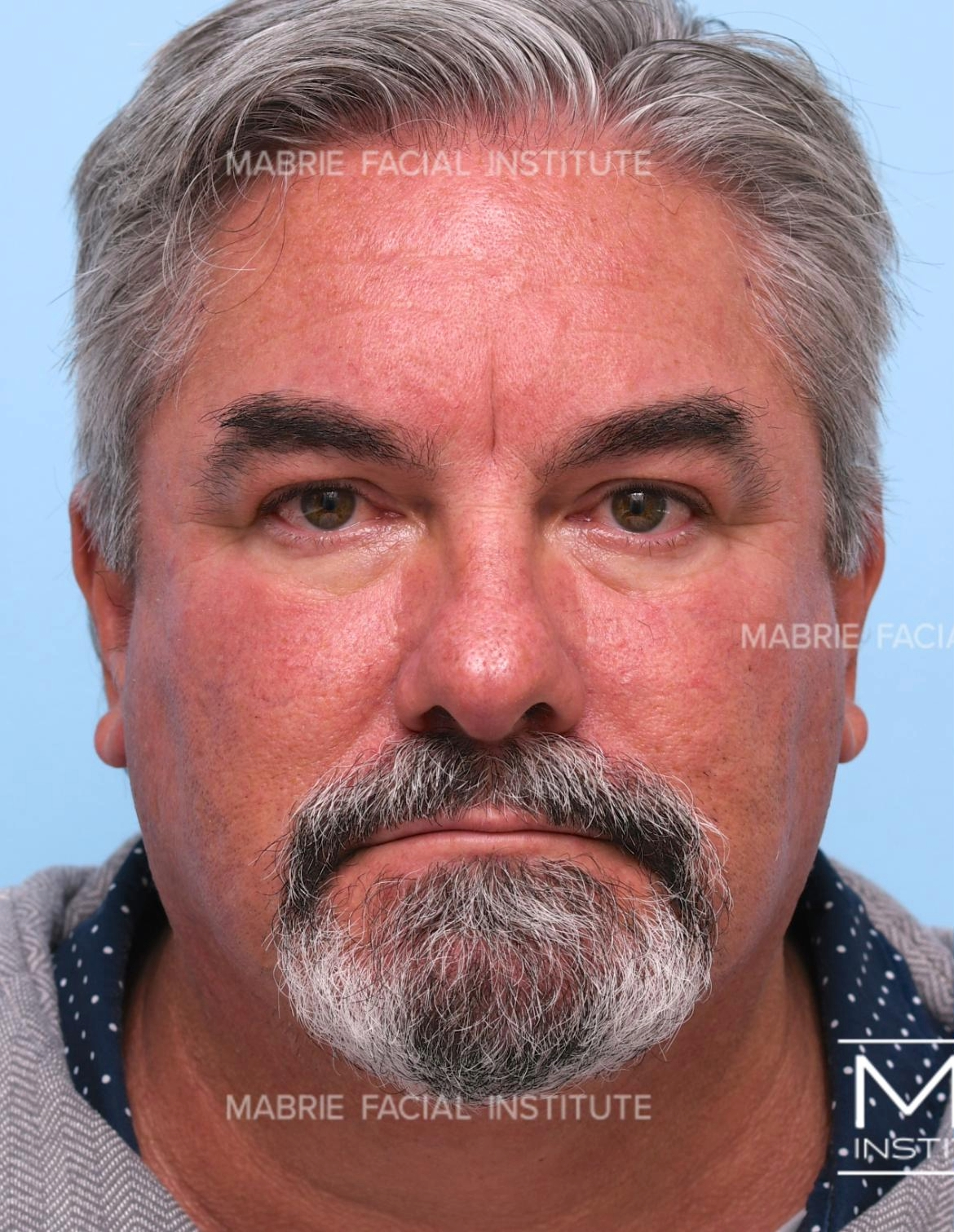 Before First BOTOX Treatment