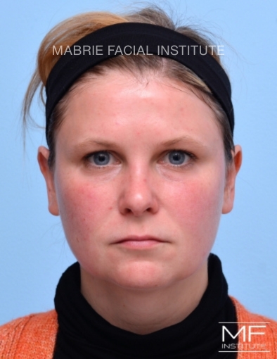woman during facial slimming treatment