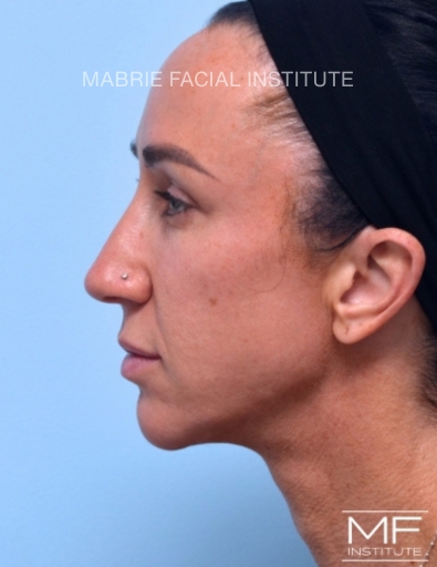 woman after jawline treatment