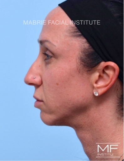 woman before jawline treatment