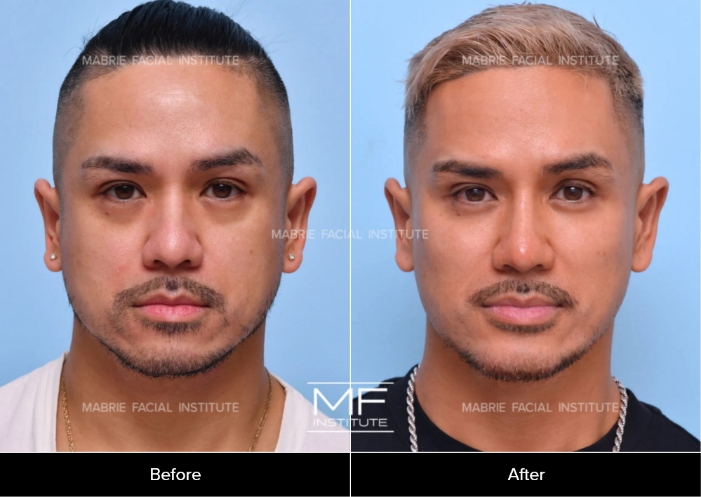 Before and after; Case 1209