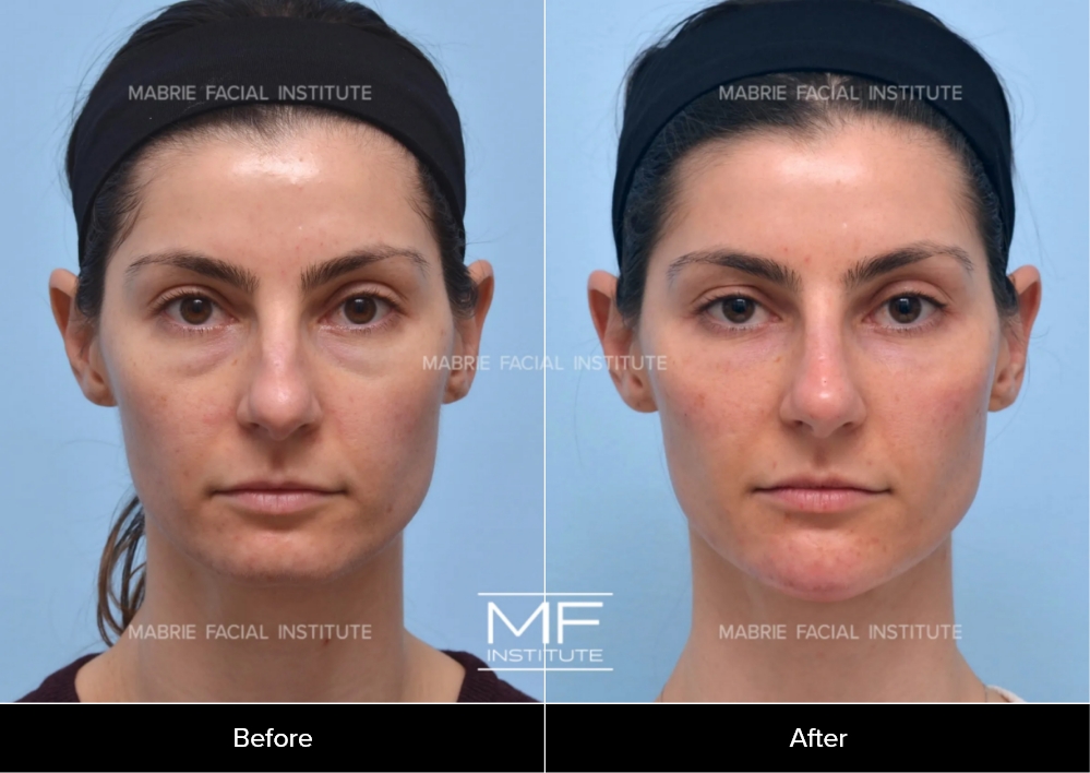 Before and after; Case 519