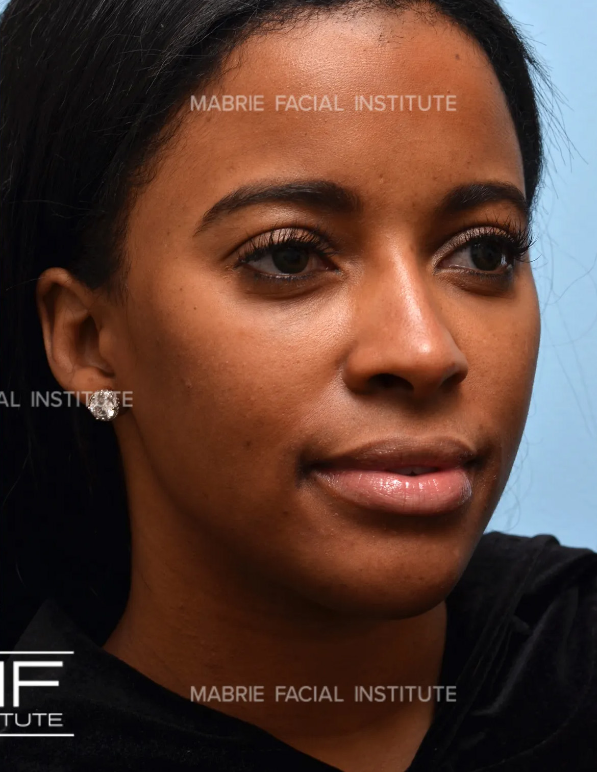 Woman after non surgical cheek augmentation with filler.