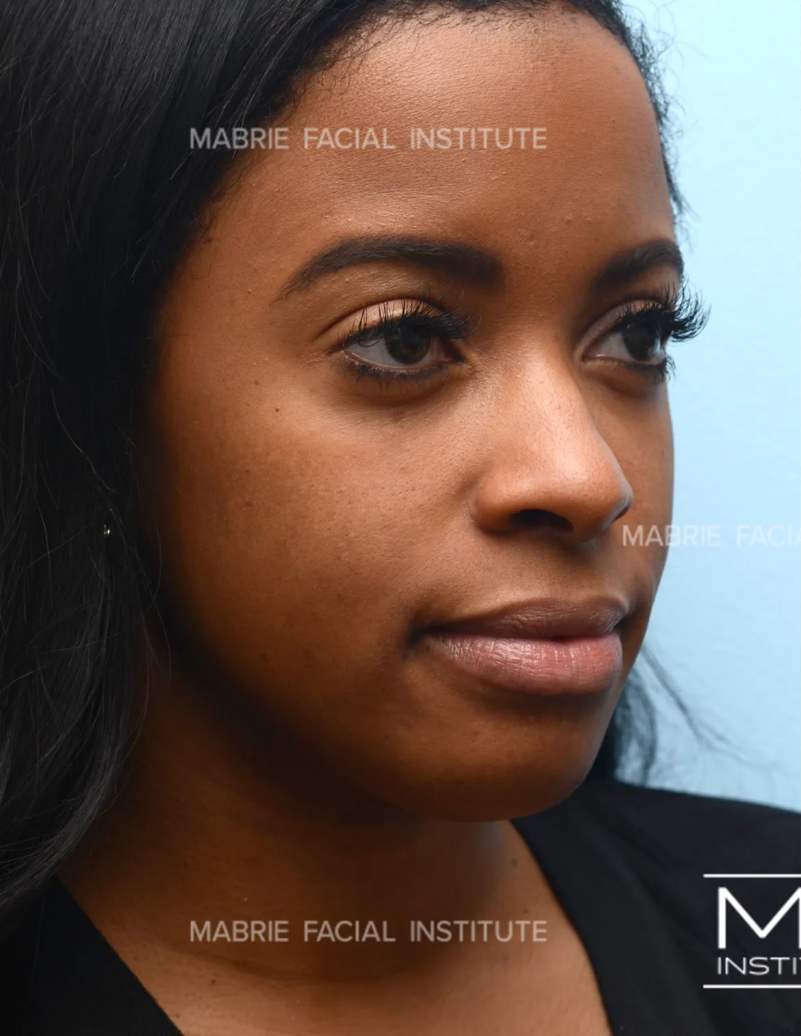 Woman before non surgical cheek augmentation with filler.