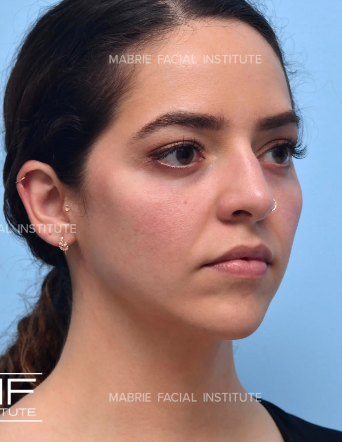 Woman after non surgical cheek augmentation with filler.
