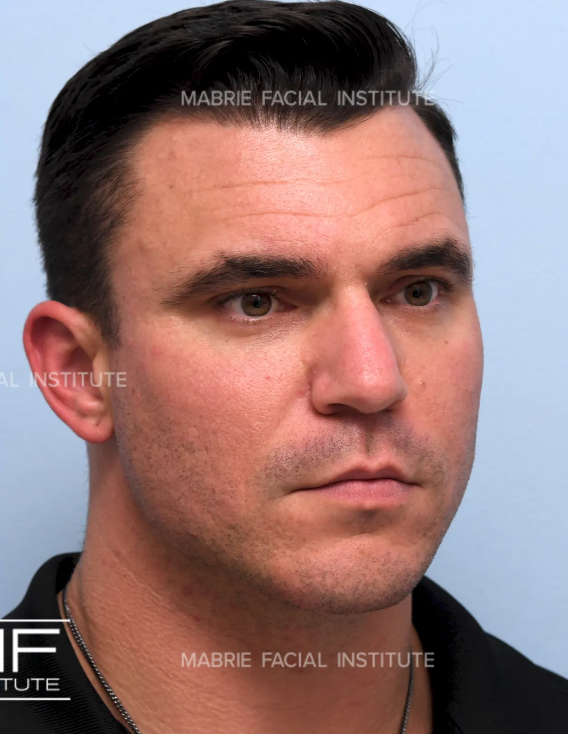 Male after jawline filler treatment.