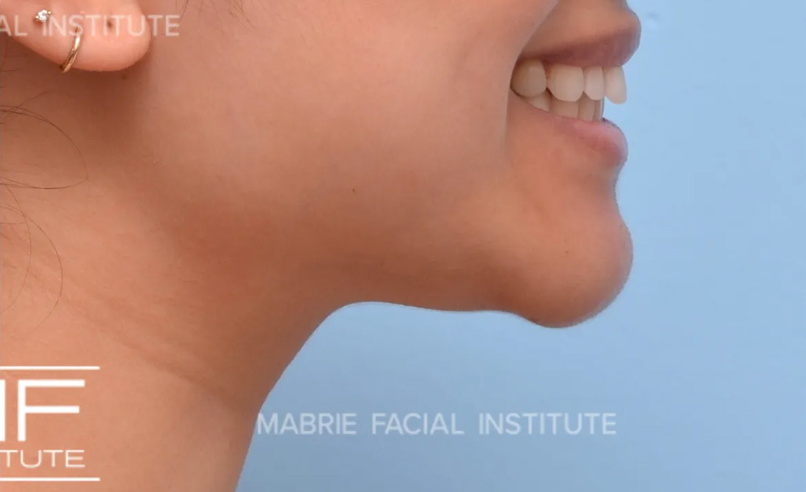 Woman after BOTOX in the Chin (Mentalis BOTOX) treatment.