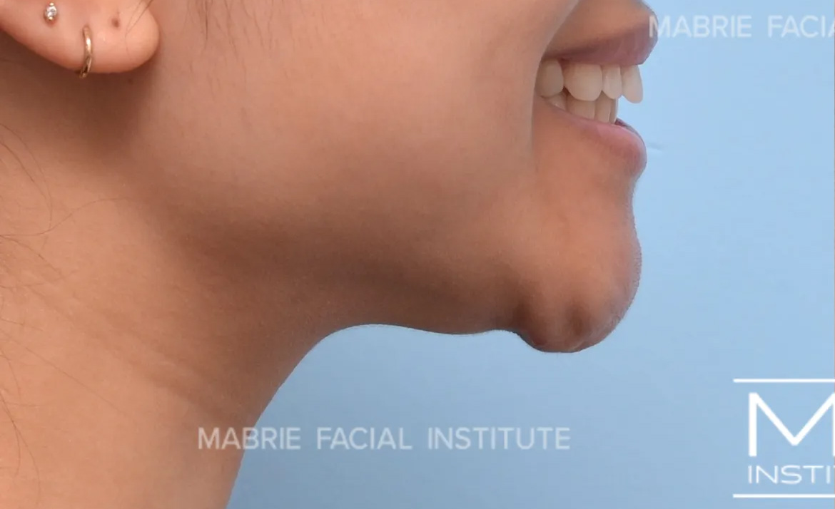 Woman before BOTOX in the Chin (Mentalis BOTOX) treatment.