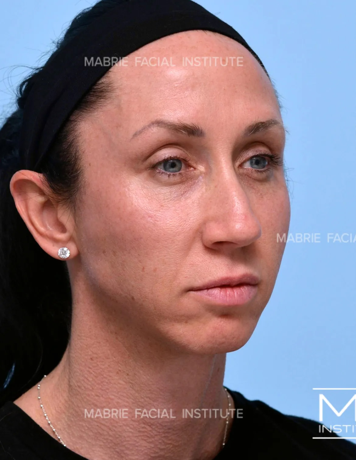 Woman before the Complete Chin and Jawline Filler Package.