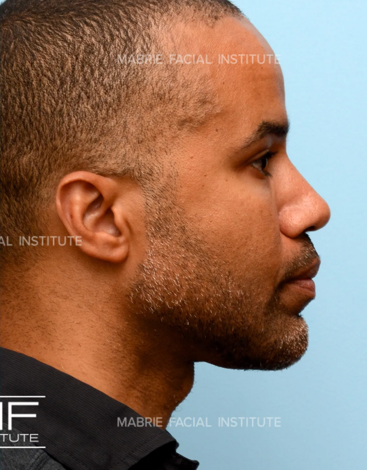 male after chin fillers