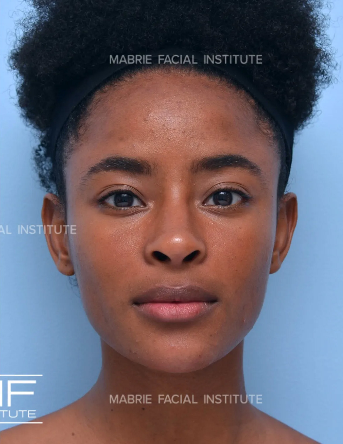 Woman after chin filler treatment.