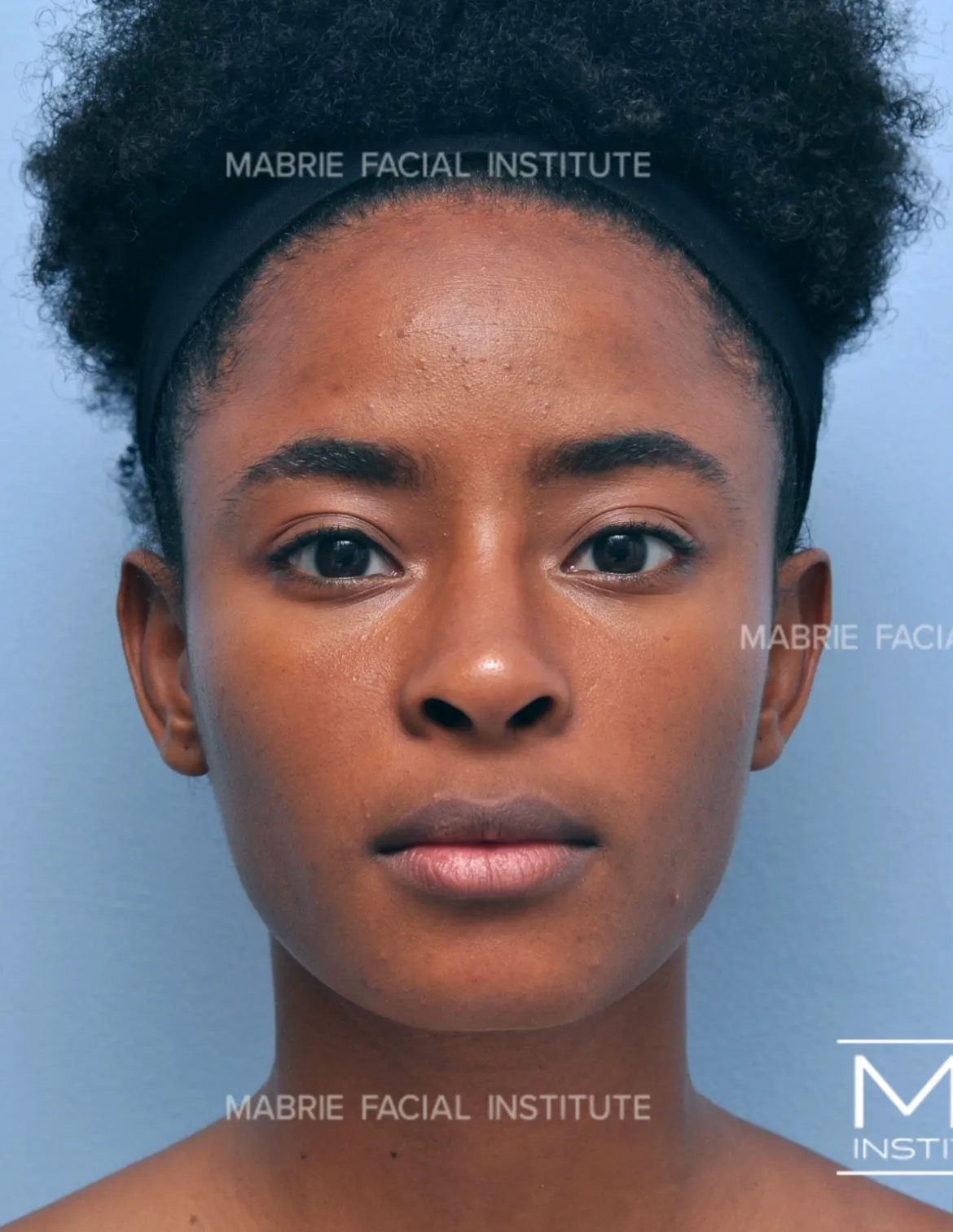 Woman before chin filler treatment.