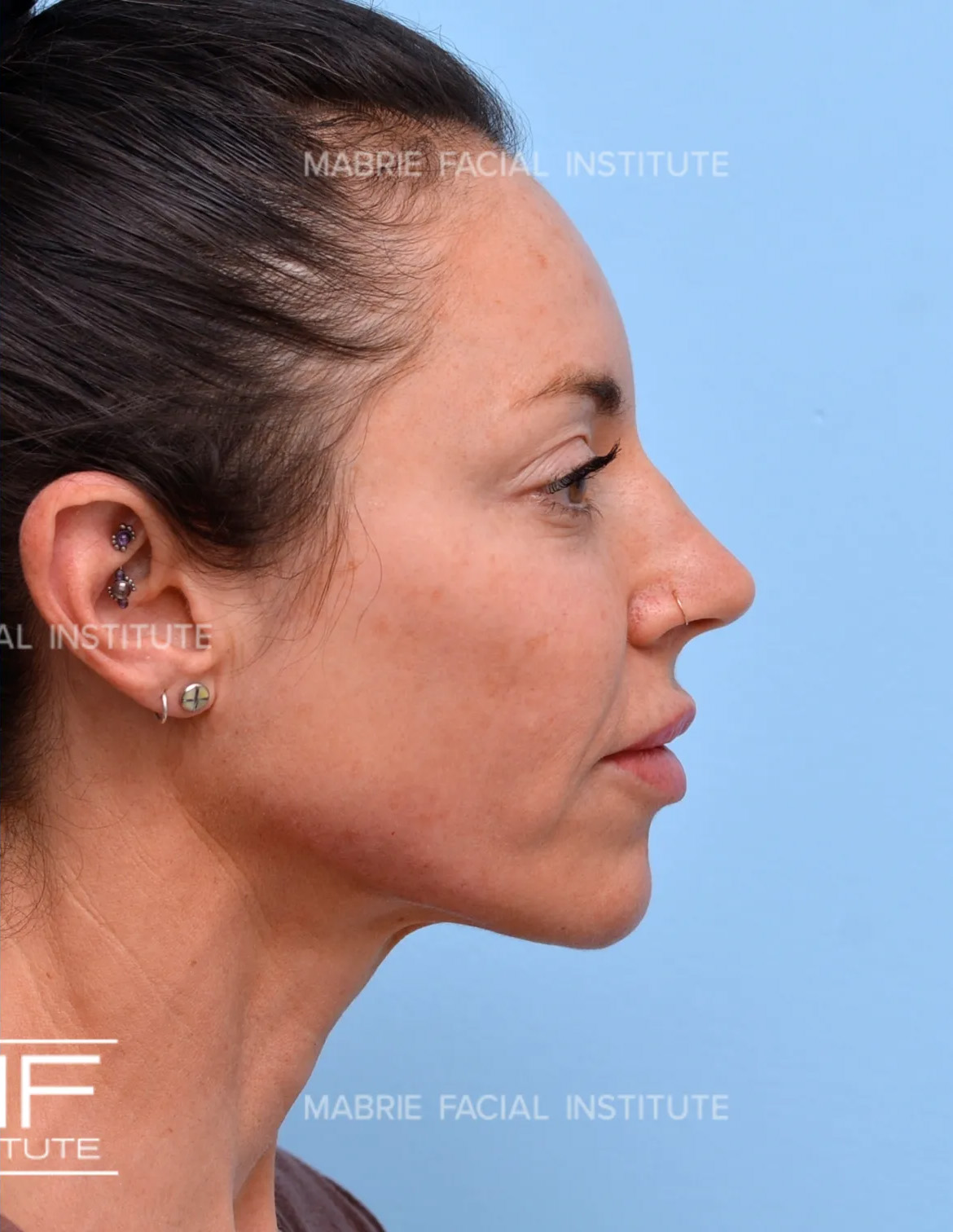 Woman after the Complete Chin and Jawline Filler Package.