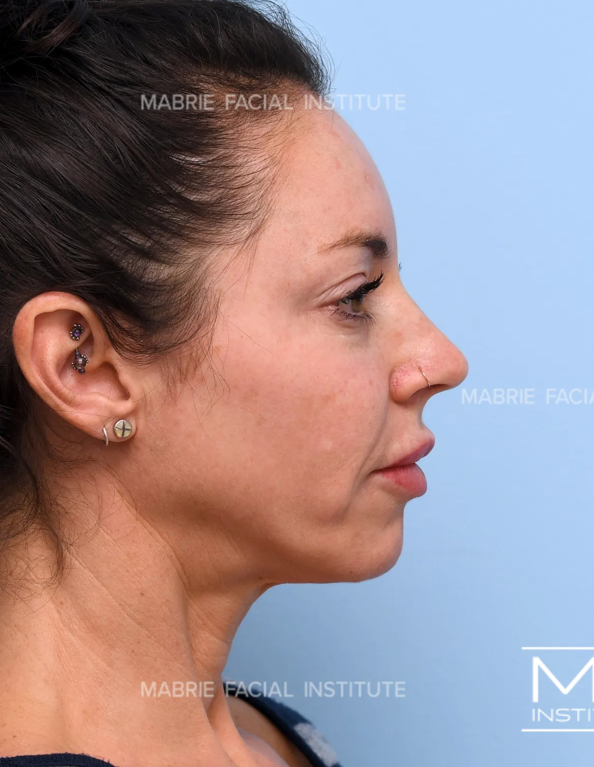 Woman before the Complete Chin and Jawline Filler Package.