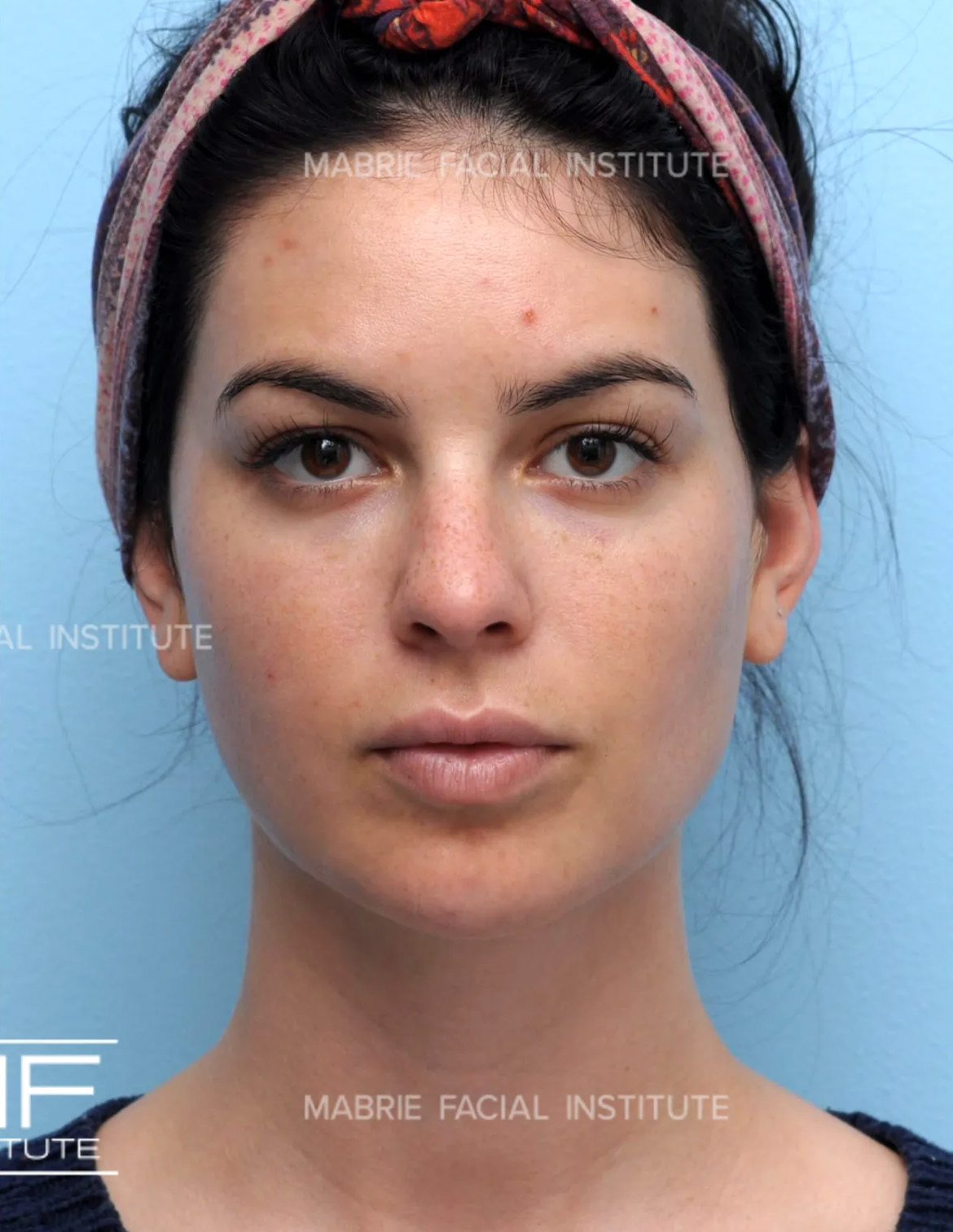 Woman after chin filler treatment.
