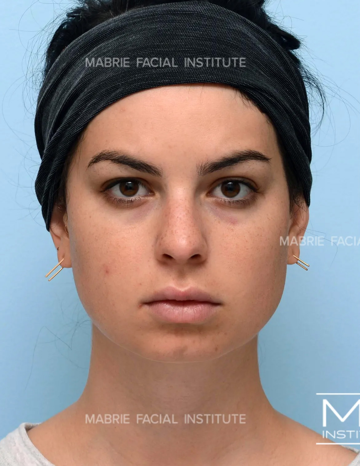 Woman before chin filler treatment.