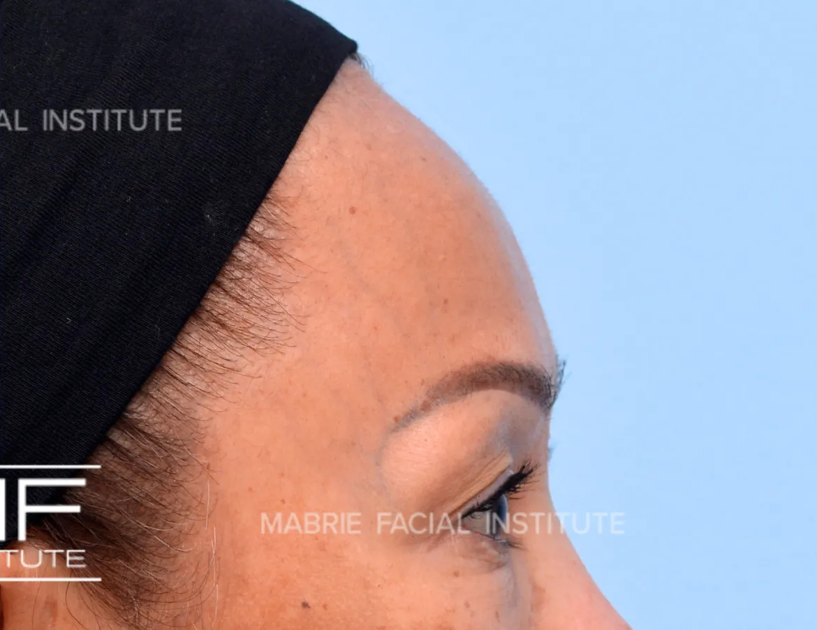 woman after forehead filler