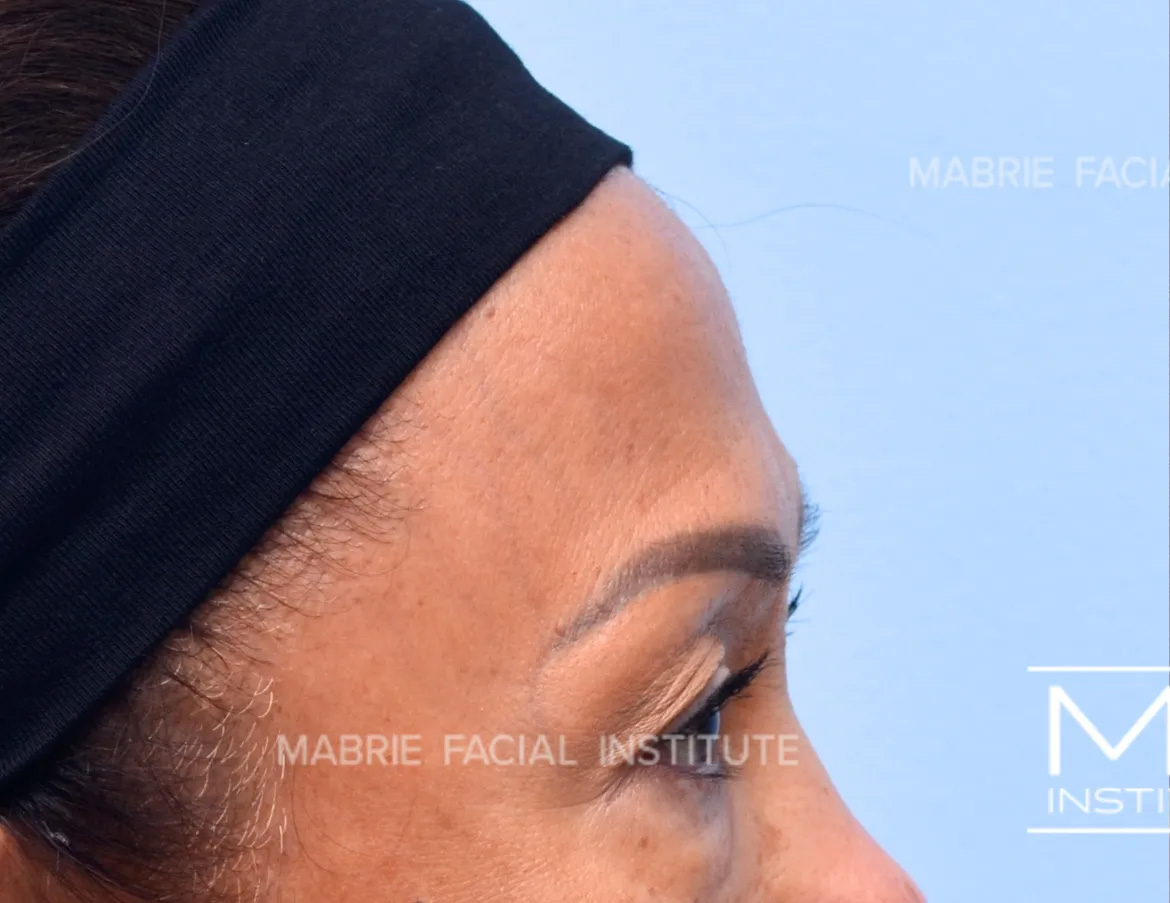 woman before forehead filler