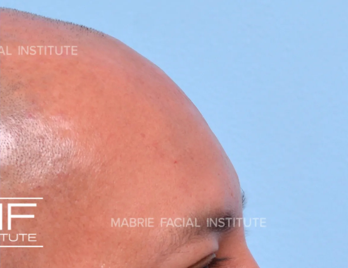 male after forehead filler