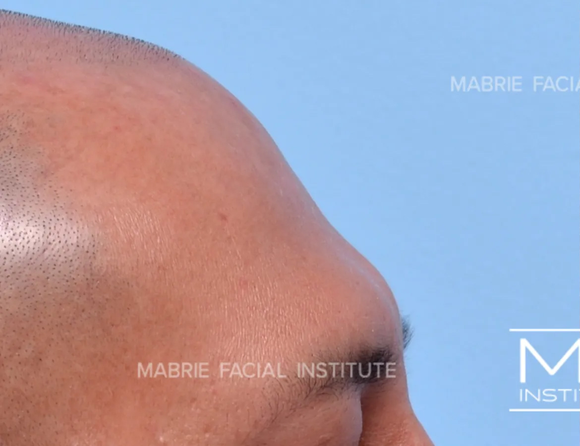 male before forehead filler