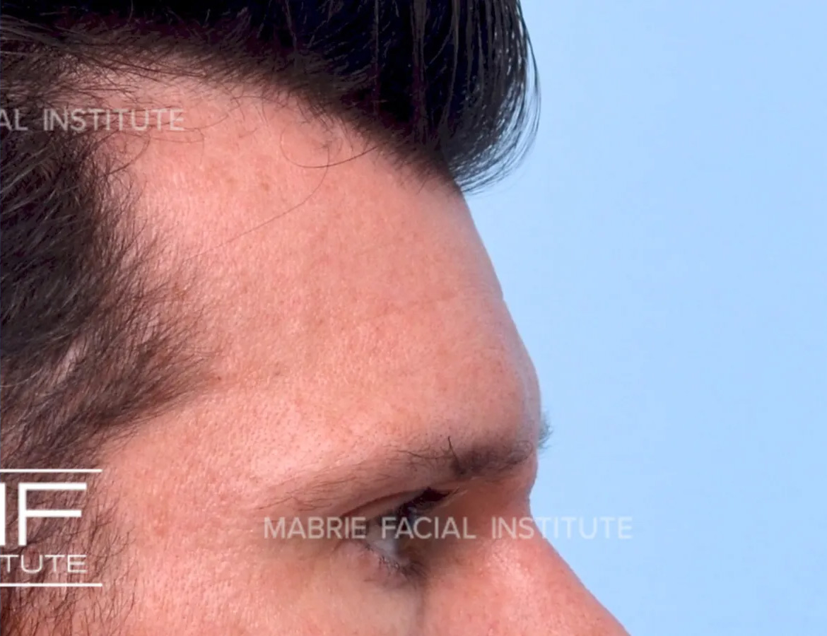 male after forehead filler