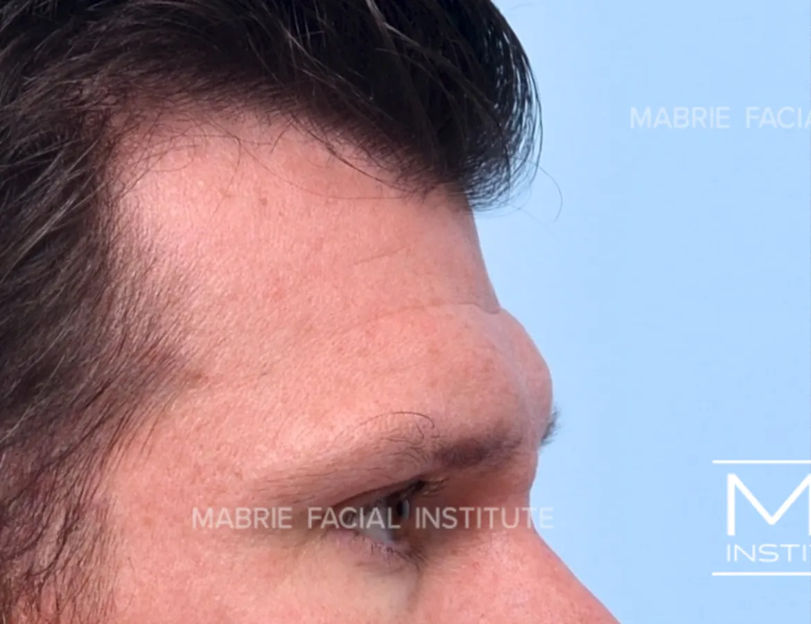 male before forehead filler