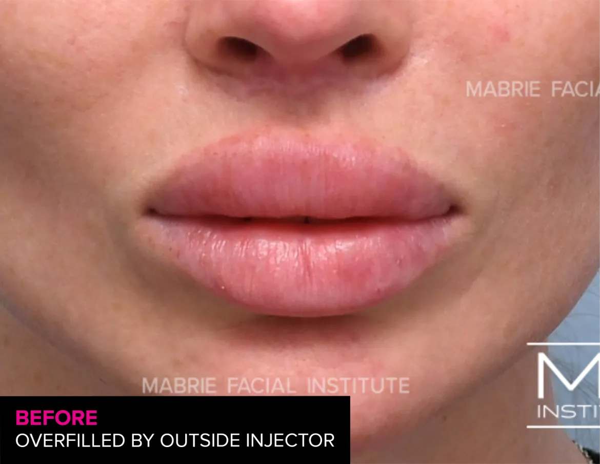 woman before lip filler correction