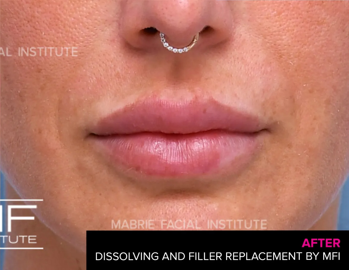 woman after lip filler correction