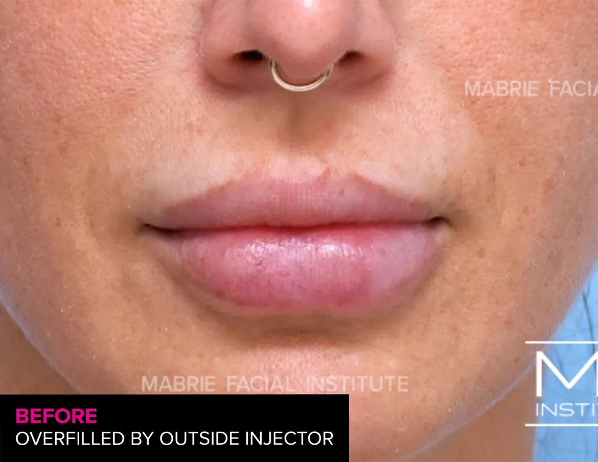 woman before lip filler correction