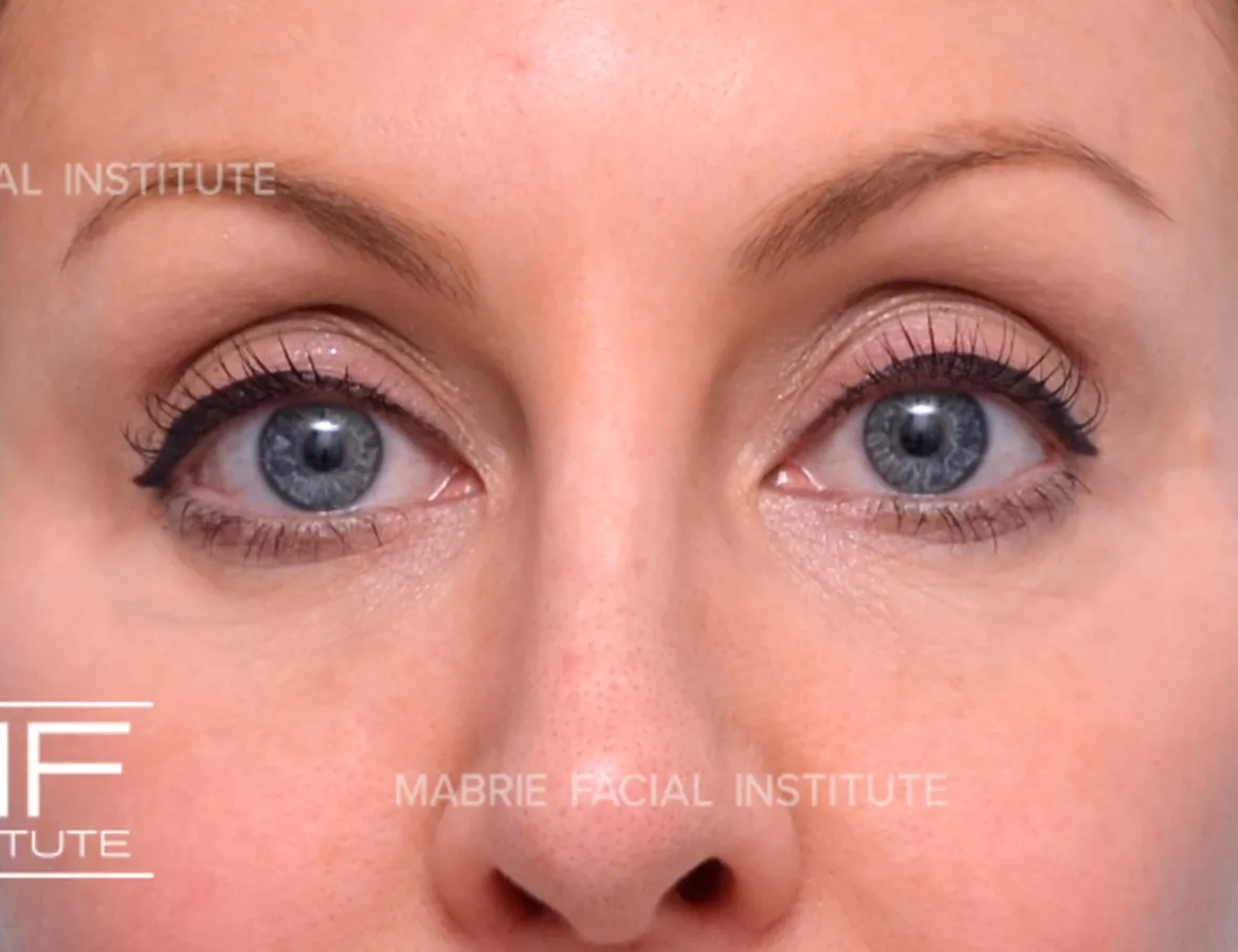woman after dissolving hyaluronic acid fillers under the eyes