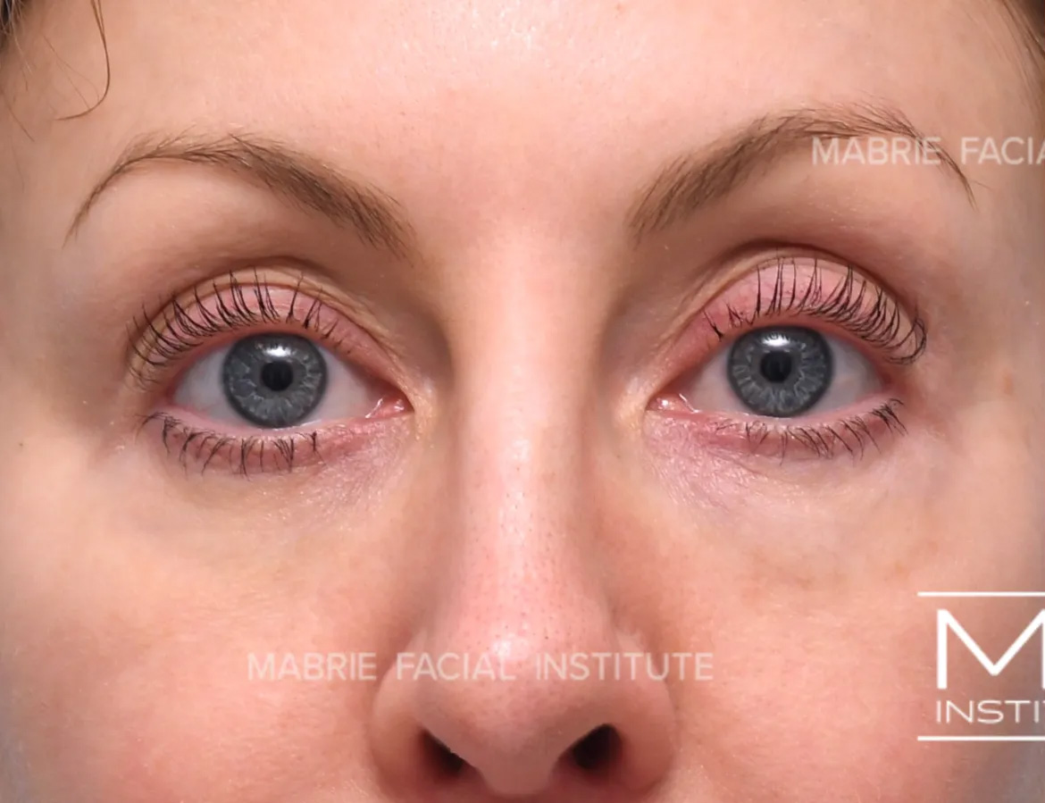 woman before dissolving hyaluronic acid fillers under the eyes