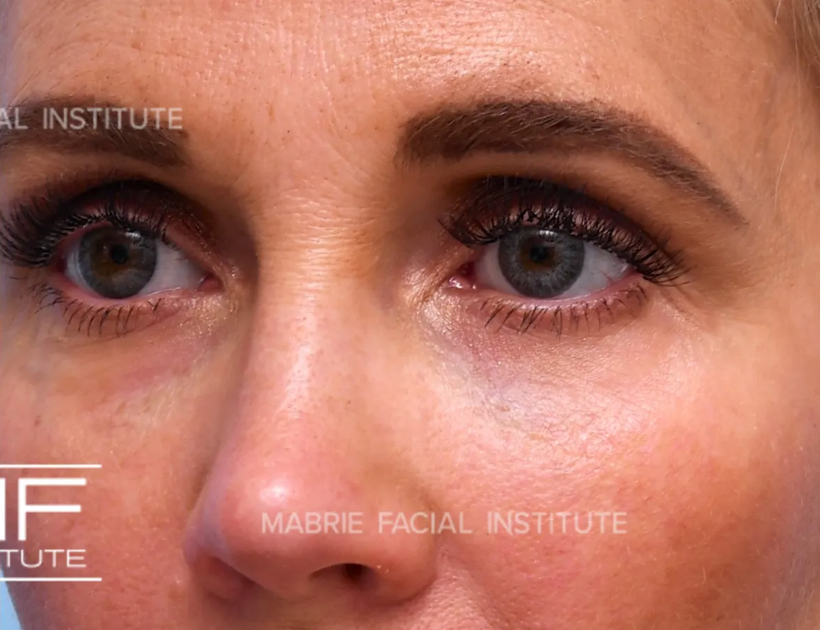 woman after dissolving hyaluronic acid fillers under the eyes