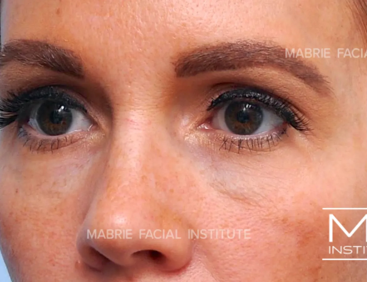 woman before dissolving hyaluronic acid fillers under the eyes