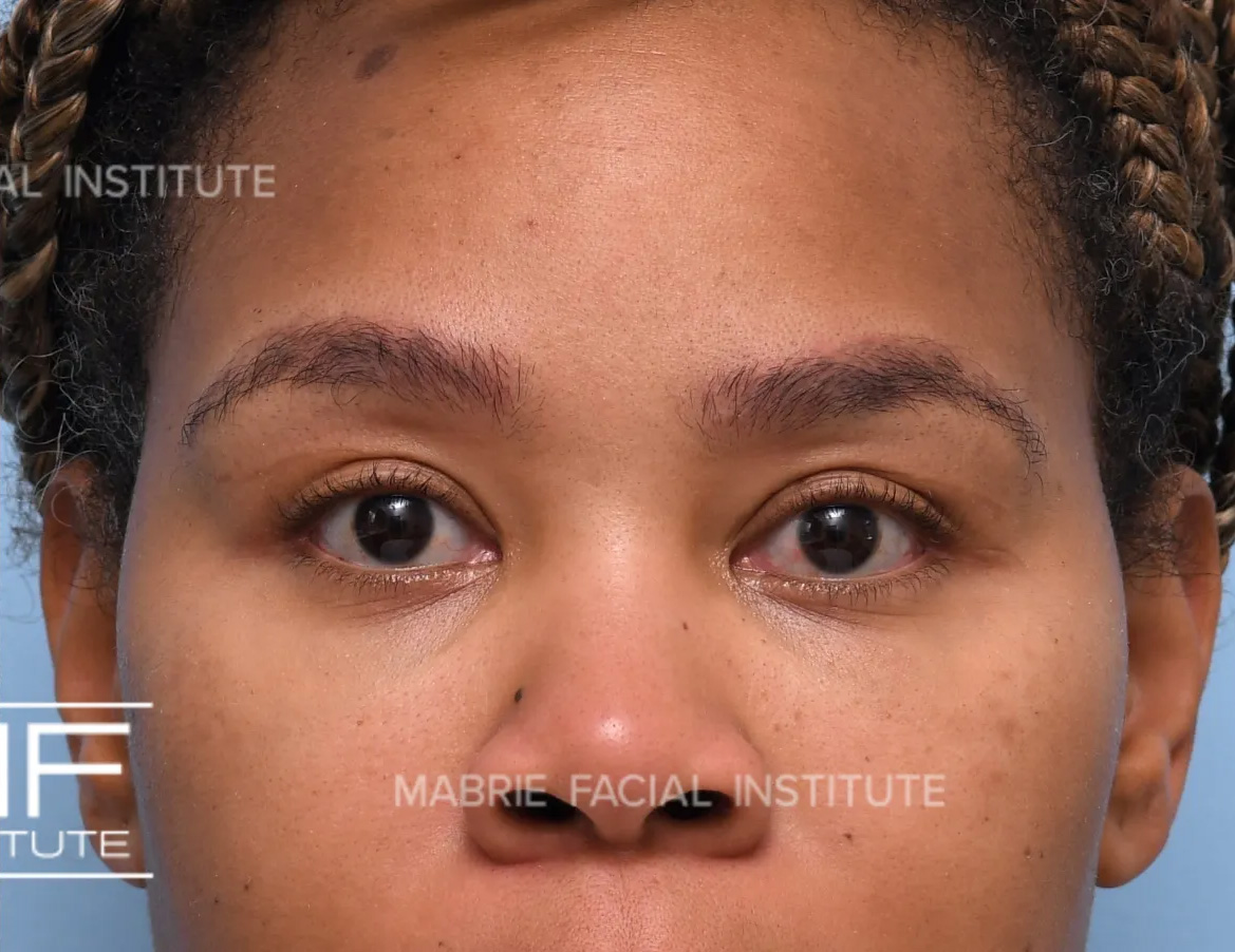 woman after dissolving hyaluronic acid fillers under the eyes