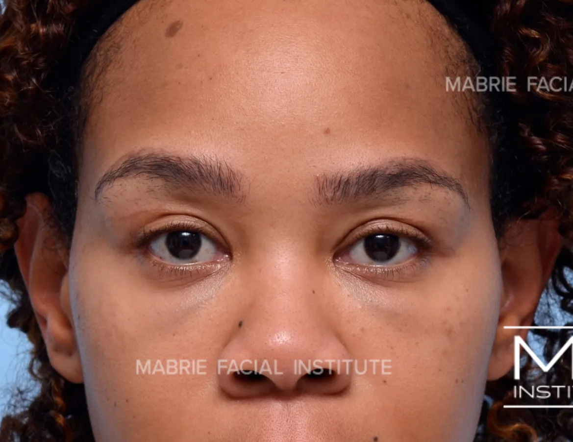 woman before dissolving hyaluronic acid fillers under the eyes