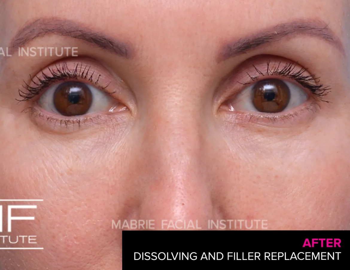 woman after dissolving hyaluronic acid fillers under the eyes