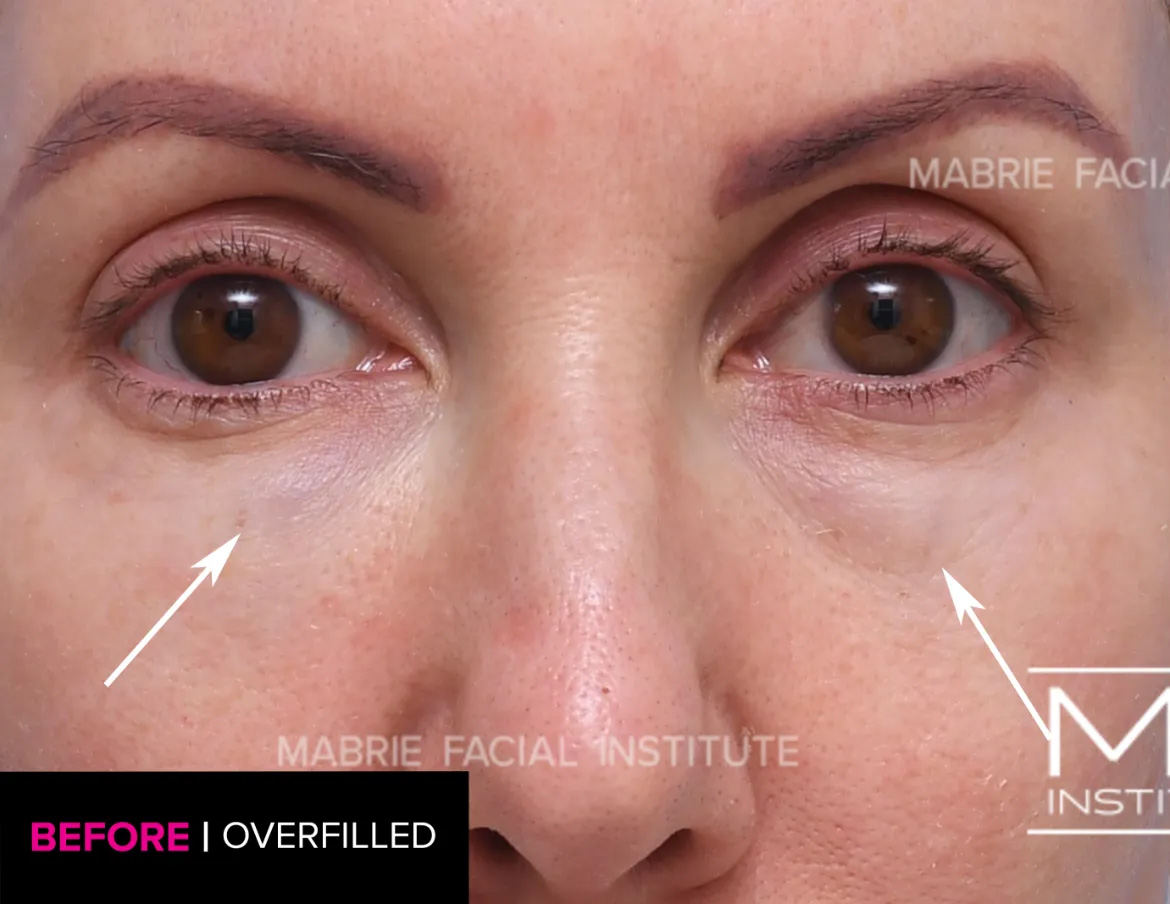 woman before dissolving hyaluronic acid fillers under the eyes