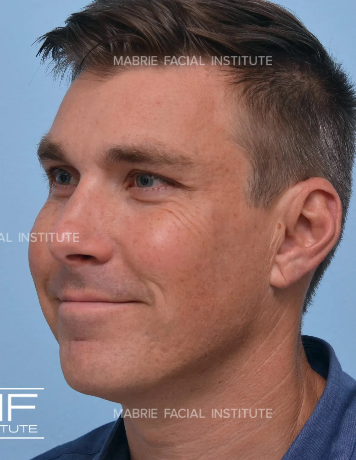 male after crows feet botox treatment