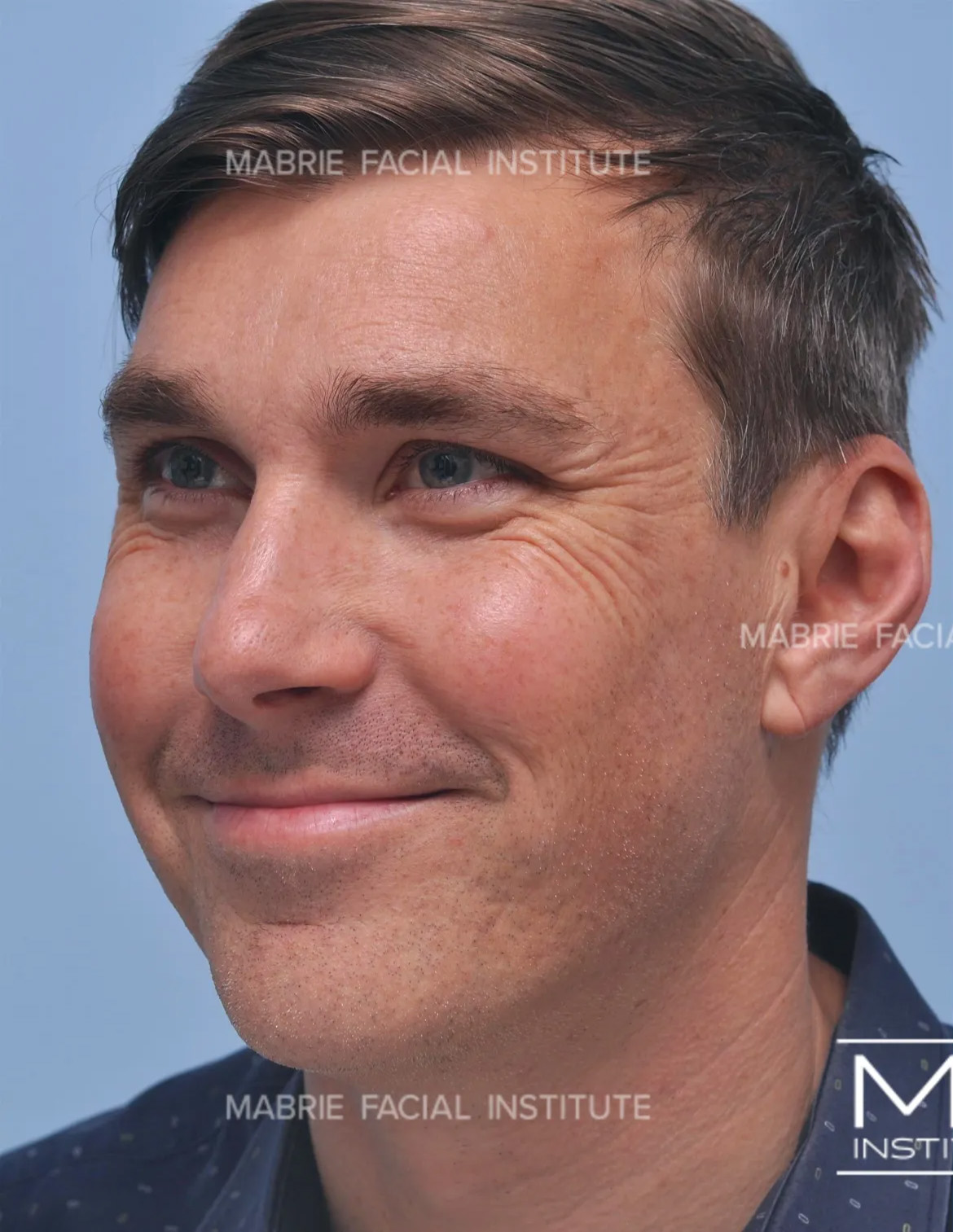 male before crows feet botox treatment