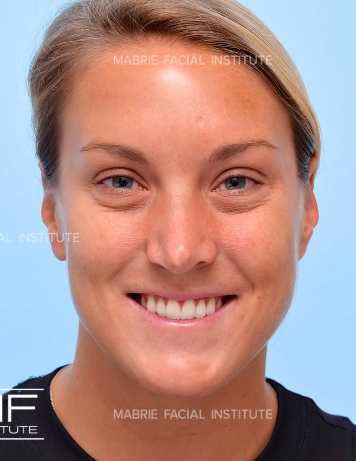woman after crows feet botox treatment